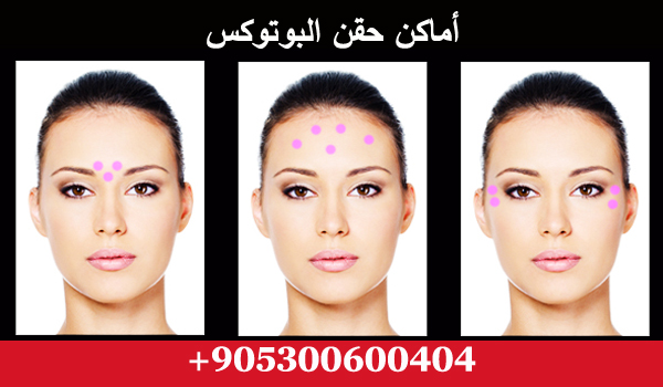 علاج حقن البوتوكس في تركيا