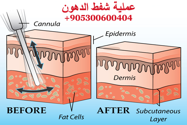 عملية شفط الدهون في تركيا