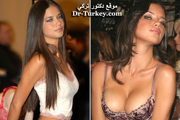 عملية تكبير الصدر في تركيا