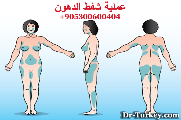 عملية شفط الدهون في تركيا