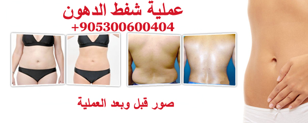 عملية شفط الدهون بالليزر والفيزر في تركيا