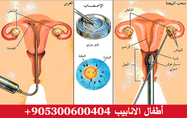 اطفال الانابيب في تركيا