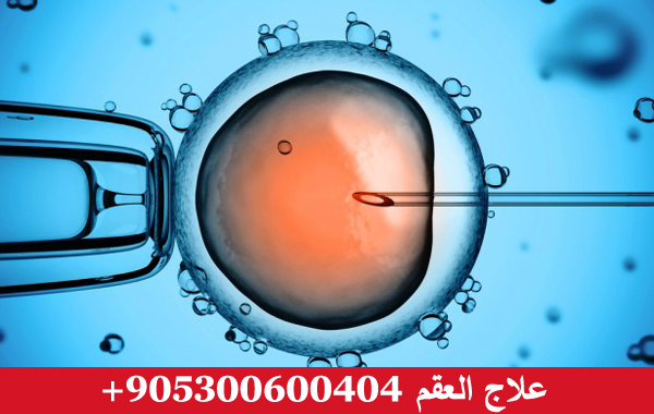 علاج العقم في تركيا