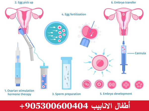 عملية اطفال الانابيب في تركيا
