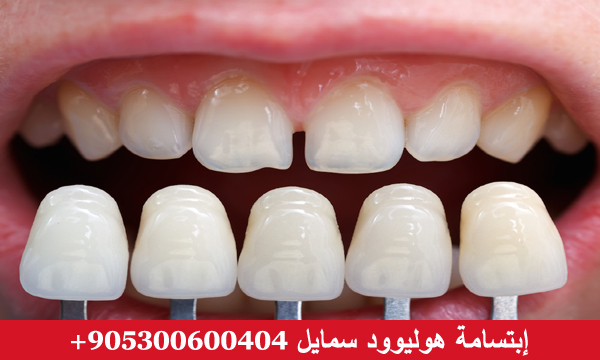 عدسات الاسنان الفينير واللومينير في تركيا